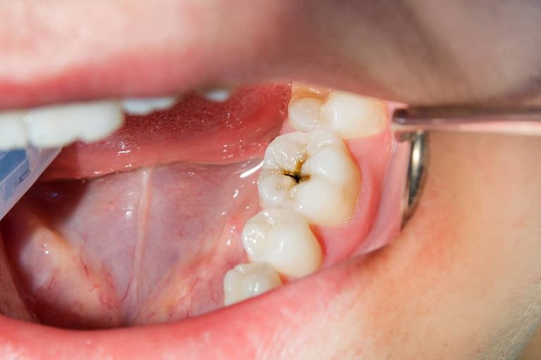 composite fillings