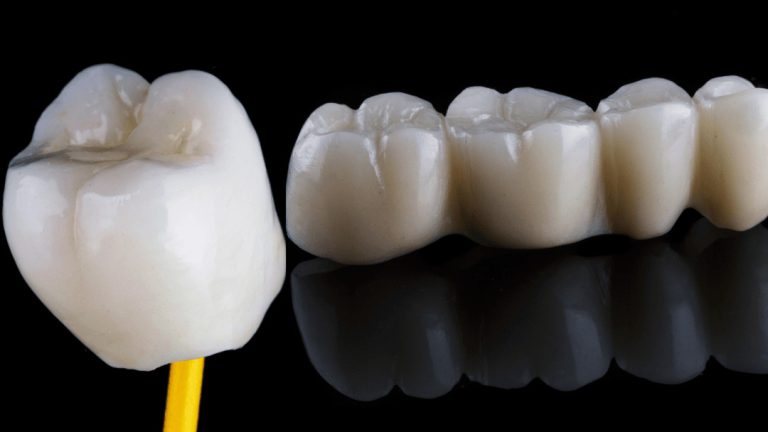 dental crowns and bridges