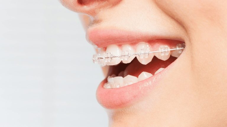 issues do braces