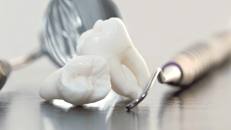 wisdom tooth removal in se calgary