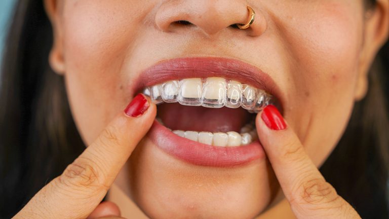 indian-woman-showing-her-Invisalign.jpg