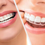 Invisalign vs Braces